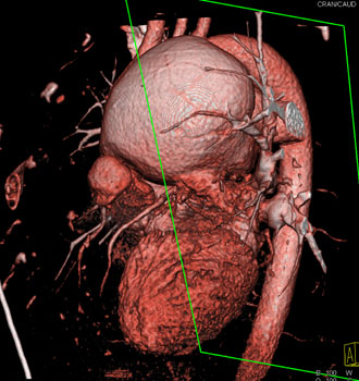 cardiac 64 mdct