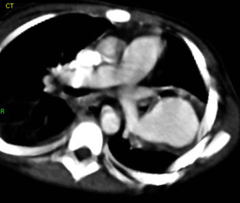 cardiac 64 mdct