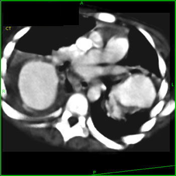 cardiac 64 mdct