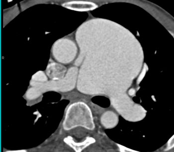 cardiac 64 mdct