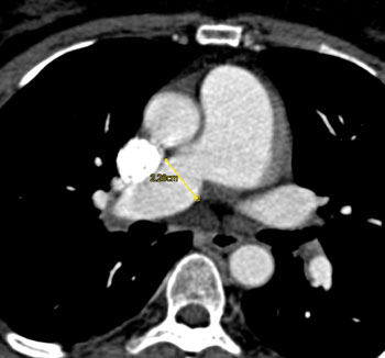 cardiac 64 mdct