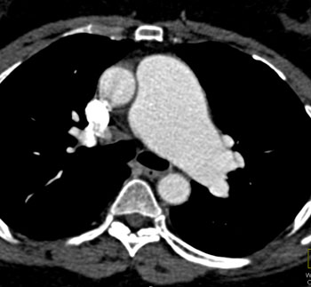 cardiac 64 mdct