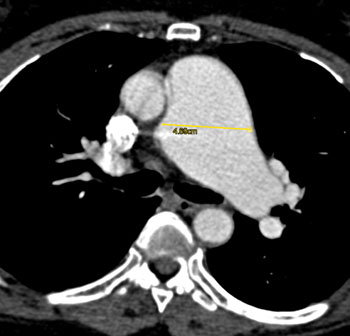 cardiac 64 mdct