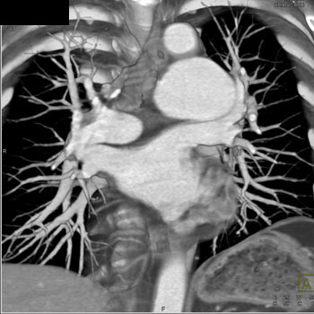 cardiac 64 mdct