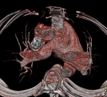 cardiac 64 mdct