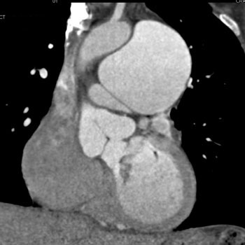 cardiac 64 mdct