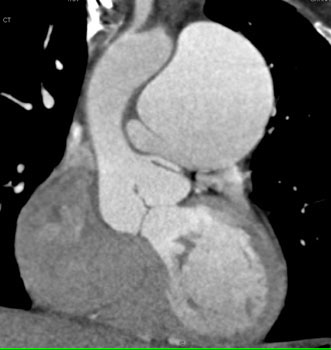 cardiac 64 mdct