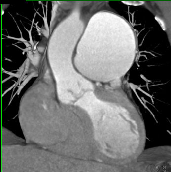 cardiac 64 mdct