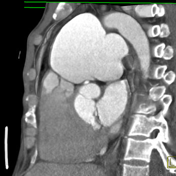 cardiac 64 mdct