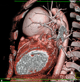 cardiac 64 mdct