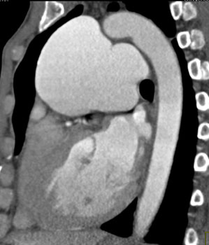 cardiac 64 mdct