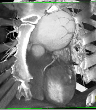 cardiac 64 mdct