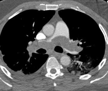 cardiac 64 mdct