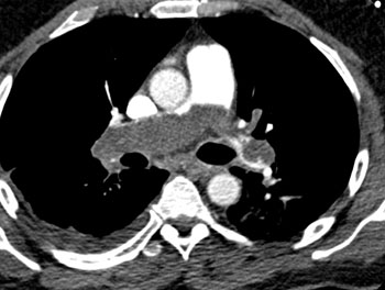 cardiac 64 mdct