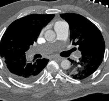 cardiac 64 mdct