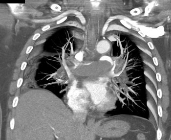 cardiac 64 mdct