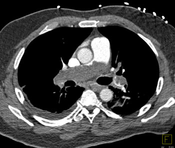 cardiac 64 mdct