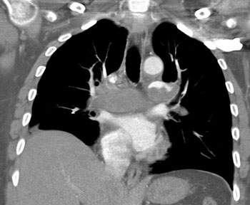 cardiac 64 mdct