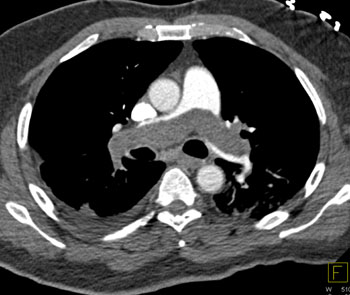 cardiac 64 mdct