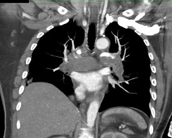 cardiac 64 mdct