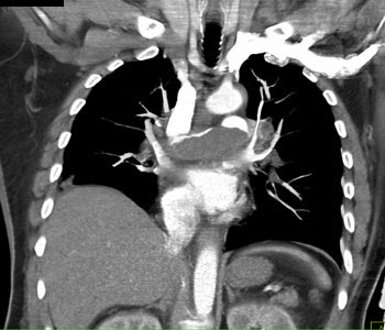 cardiac 64 mdct