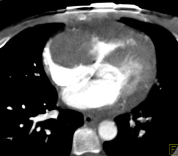 cardiac 64 mdct