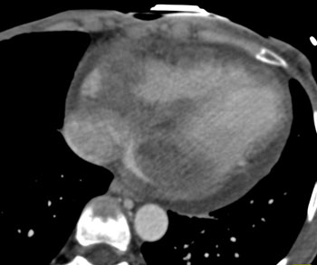 cardiac 64 mdct