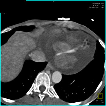 cardiac 64 mdct