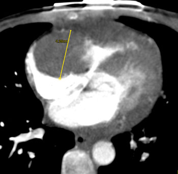 cardiac 64 mdct