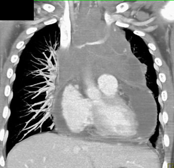 cardiac 64 mdct