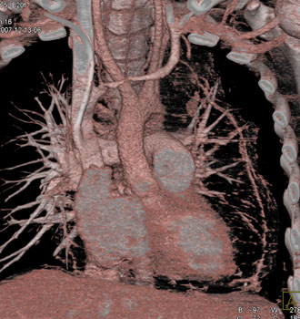 cardiac 64 mdct