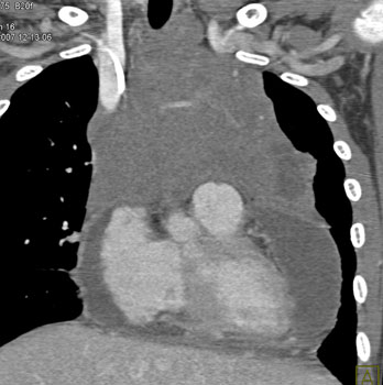 cardiac 64 mdct