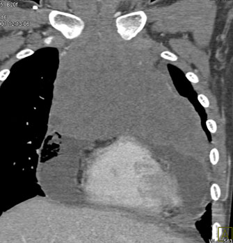 cardiac 64 mdct