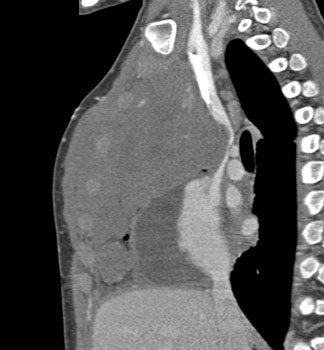 cardiac 64 mdct