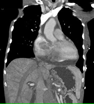 cardiac 64 mdct