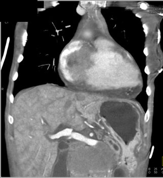 cardiac 64 mdct