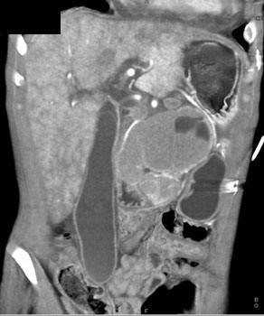 cardiac 64 mdct