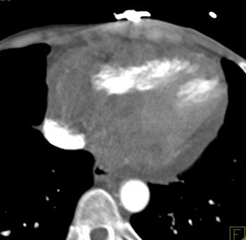 cardiac 64 mdct