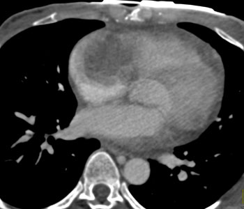 cardiac 64 mdct