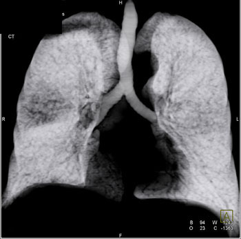 cardiac 64 mdct