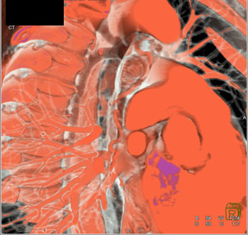 cardiac 64 mdct