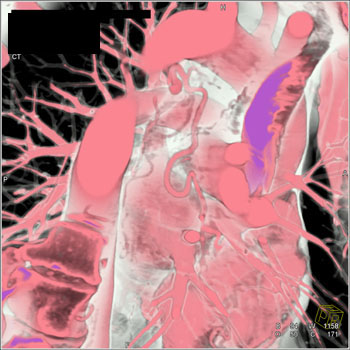 cardiac 64 mdct