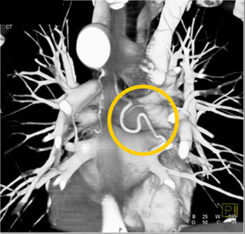 cardiac 64 mdct