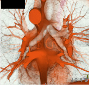 cardiac 64 mdct