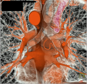 cardiac 64 mdct