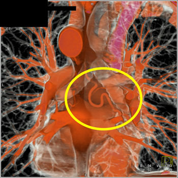 cardiac 64 mdct