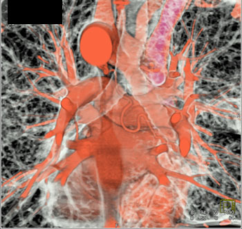 cardiac 64 mdct