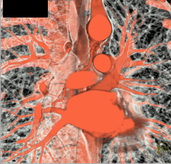 cardiac 64 mdct