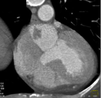 cardiac 64 mdct