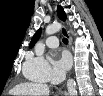 cardiac 64 mdct